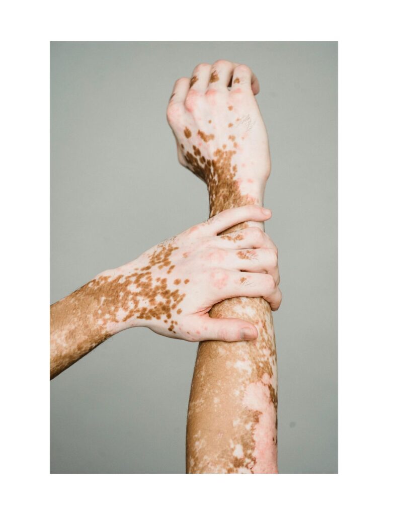 Stade 3 des maladies auto-immunes